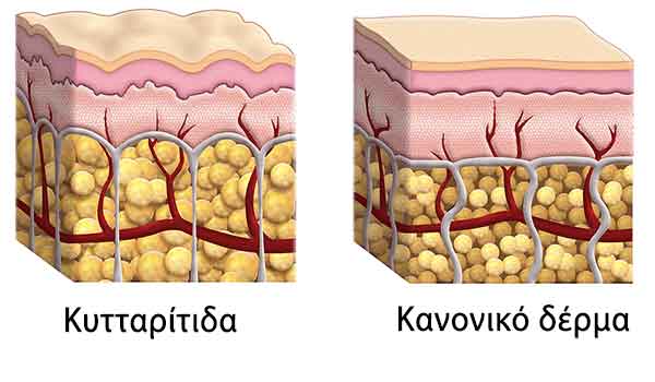 Κυτταρίτιδα και κανονικό δέρμα